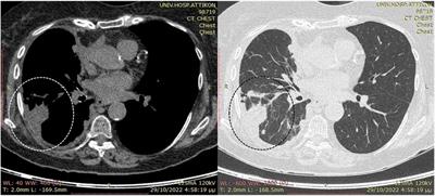 Rare cancer with primary pleural epithelioid hemangioendothelioma diagnosed by thoracoscopic biopsy achieving disease control after 16 months: case report and literature review